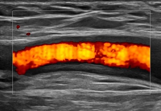 Ultraschallbild einer Vene mit Blutfluss, rot dargestellt. Kliniken Ostallgäu-Kaufbeuren.